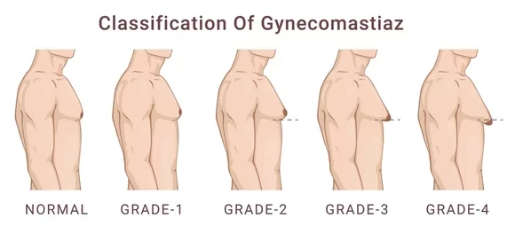 classification-gynecomastia-enlargement-male-breast-260nw-2259395919